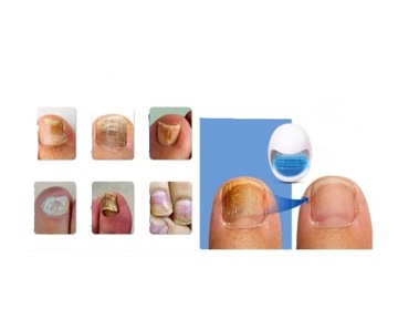 LASEROWE URZĄDZENIE DO LECZENIA GRZYBICY PAZNOKCI