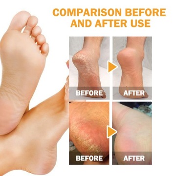3 szt. Spray do usuwania zrogowaceń na piętach 30 ml nawilżający TW