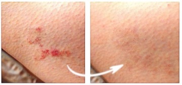 LANA Cosmetics preparat do skóry atopowej 100 ml