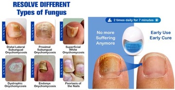 Лазерный аппарат для лечения грибка ногтей