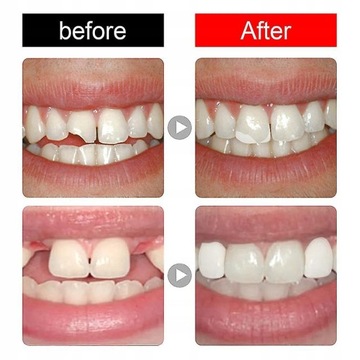 Moldable Tooth Filling False Teeth Temporary
