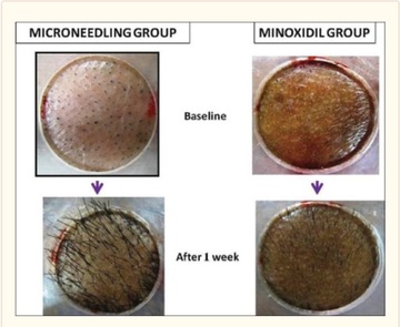 Дермароллер Derma Roller 1,0мм от облысения, лишая