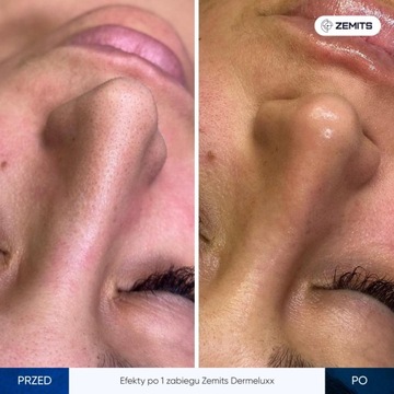 Устройство для водной дермабразии и инфузии кислорода Zemits DermeLuxx