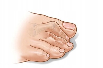 КРЫШКА HAMMER TOE, ЗАЩИТА ПОЛОТНА VAYA