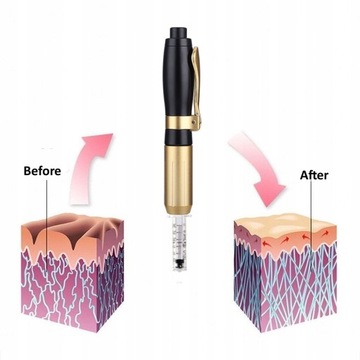 Безыгольный инъектор с гиалуроновой кислотой.