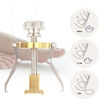 Подологический зонд для вросших долотообразных ногтей