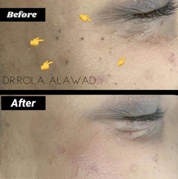 Мазь для удаления кондилом вульвы и бородавок