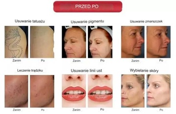 Nd Yag Laser 4in1 IQPRO Удаление волос с татуировкой Электролиз OPT IPL