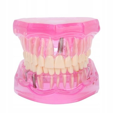 IMPLANTY DENTYSTYCZNE MODEL ZĘBÓW DENTYSTA