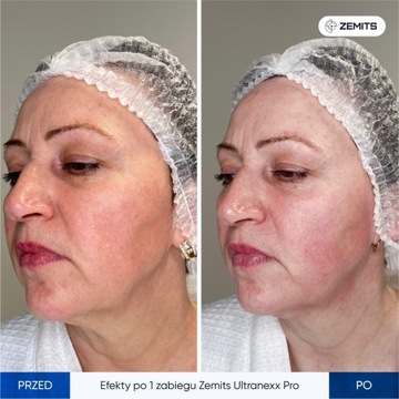 Подъемное устройство SMAS Zemits UltraNexx Pro