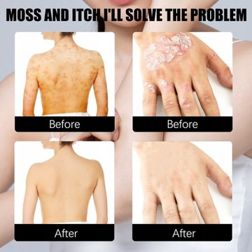 30 мл спрей от псориаза кожи, натуральные травы, экзема