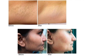 Adonyss DioPulse 808 Диодный лазер для эпиляции