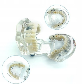 Dental Model zębów patologii naprawa Model z nerw