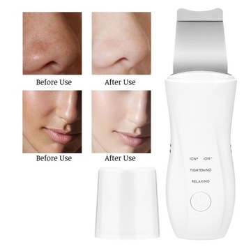 Ультразвуковой пилинг кожи в домашних условиях для удаления черных точек S2