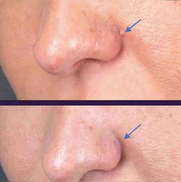 Мазь для удаления кондилом вульвы и бородавок