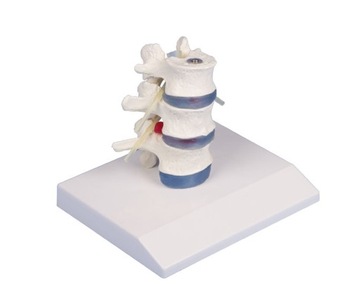 Model anatomiczny kręgów lędźwiowych z przepukliną dysku Erler Zimmer
