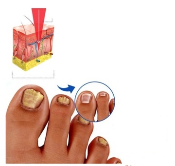 LASEROWE URZĄDZENIE DO LECZENIA GRZYBICY PAZNOKCI