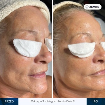 Аппарат для электропорации Zemits Klein EL