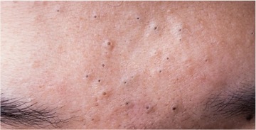 Аппарат для удаления черных точек и выдавливания прыщей - КОМПЛЕКТ