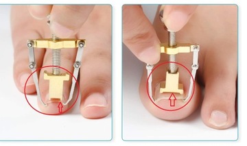 Набор от вросших ногтей BUCKLE CORRECTOR box