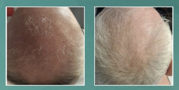 Энзимный пилинг кожи головы 50 мл TRICHO T-derm Series
