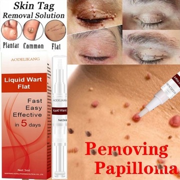 Средство для удаления родинок и бородавок