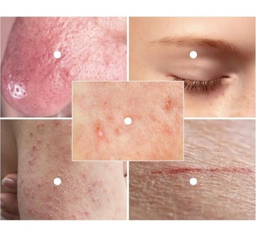 1 ПК с брызги с гипохлористой кислотой для всех типов кожи