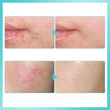 1 ПК с брызги с гипохлористой кислотой для всех типов кожи