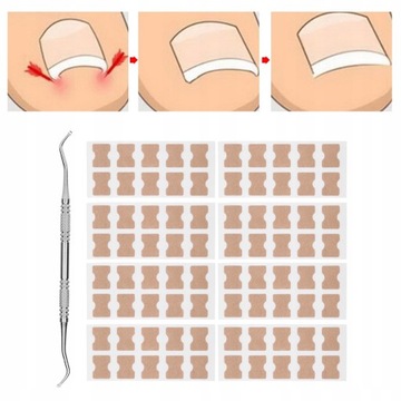8x PATCH STRIPES для вросших ногтей на ногах.