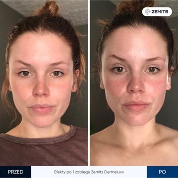 Устройство для водной дермабразии и инфузии кислорода Zemits DermeLuxx