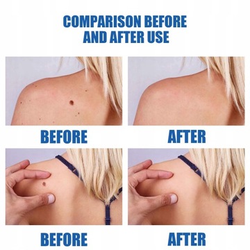 Средство для удаления меток и бородавок Anti Remedy Learty Pen Pen