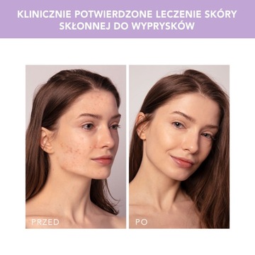 FOREO ESPADA 2 PLUS средство для лечения и удаления прыщей