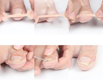 Пластыри корректирующие от вросших ногтей, 4 шт.