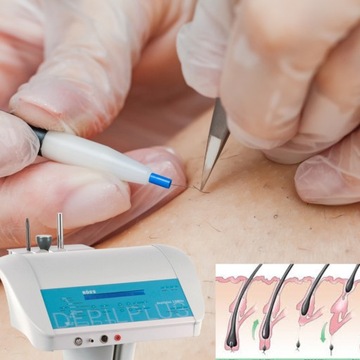 Профессиональный электроэпилятор 13 МГц.