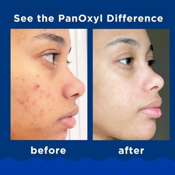 PANOXYL ACNE БЕНЗОИЛПЕРОКСИД ОЧИЩАЮЩАЯ ПЕНКА 10% 170 Г