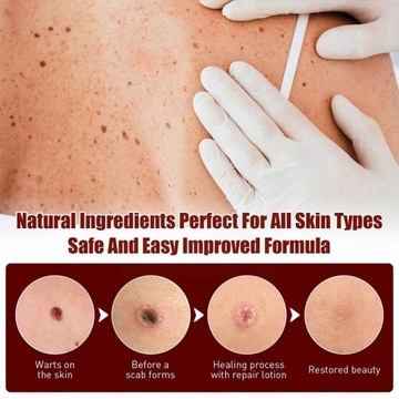 Wipe Off Tags Moles Remover Skin Tags Mole Remover