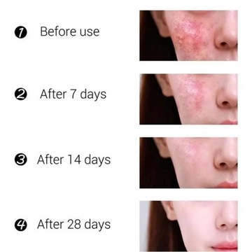 Эффективный крем для удаления прыщей, травяные пятна от прыщей, масло от прыщей