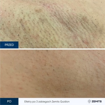 Трехлучевой лазер для эпиляции Zemits Quidion 755, 808, 1064 нм.