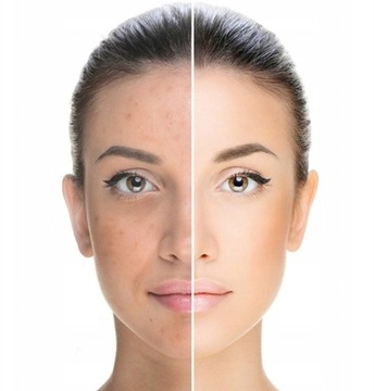 DARSONVAL DERMA WAND DARSONWAL PRO MOCNY 4 PELOTY PREZENT PŁATKI POD OCZY