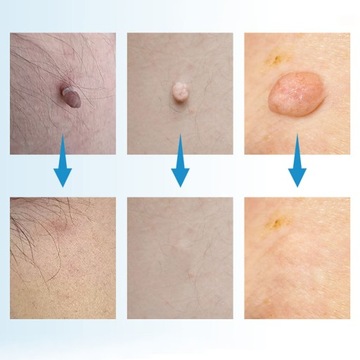 Набор для удаления бородавок Skin Tag