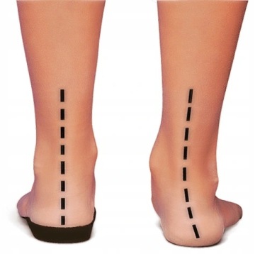 FootWave Hallux ORTHOPEDIC INSERTS размер XS 35-38