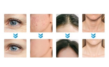 ДАРСОНВАЛЬ DERMA WAND 4 PELOTS PRO ДАРСОНВАЛЬ ДЛЯ КОЖИ ЛИЦА СИЛЬНАЯ