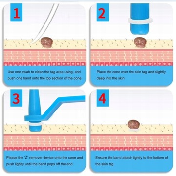 Tag skóry Zabij opaska do usuwania brodawek