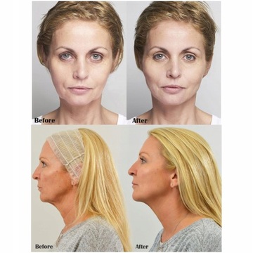 БЕЛКО-КОЛАГЕНОВЫЕ ЛИФТИНГОВЫЕ НИТИ 12 ШТ.