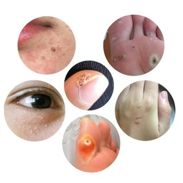 10 мл жидкость для лечения бородавок на теле, жидкость для удаления бородавок, анти