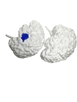 Model mózgu z glejakiem w technice 3D