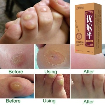 Против родинок и генитальных бородавок