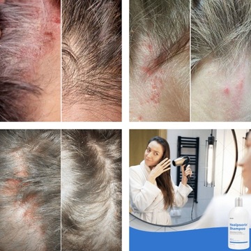 Псориаз AZS ŁZS Экзема Hermz Healpsorin Шампунь