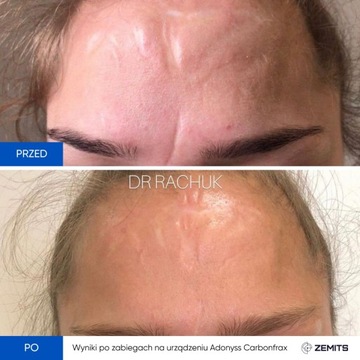 Фракционный лазер Adonyss CarbonFrax CO2