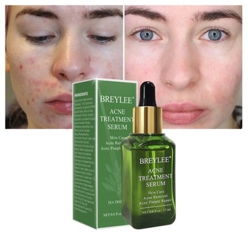 SERUM DO LECZENIA TRĄDZIKU BREYLEE 17ml Trądzik Pryszcze Serum do usuwania
